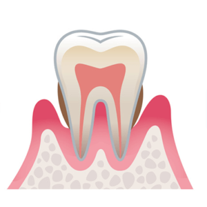歯周病中等
